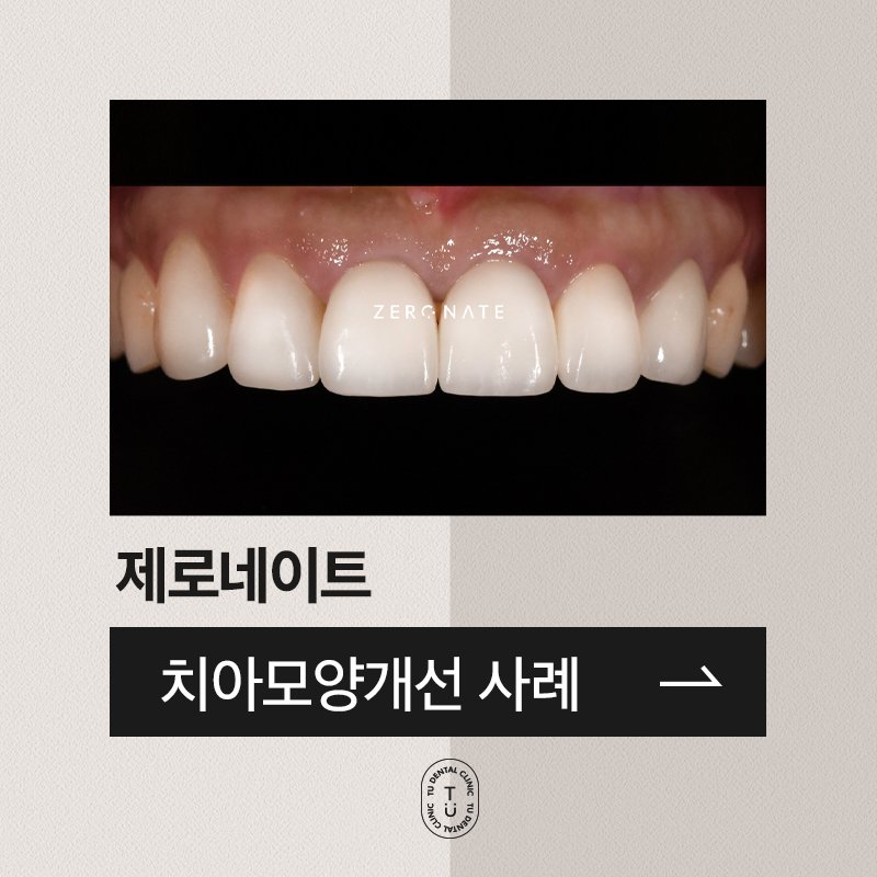 TU치과 제로네이트 사례 : 치아모양 개선 관련 이미지 1