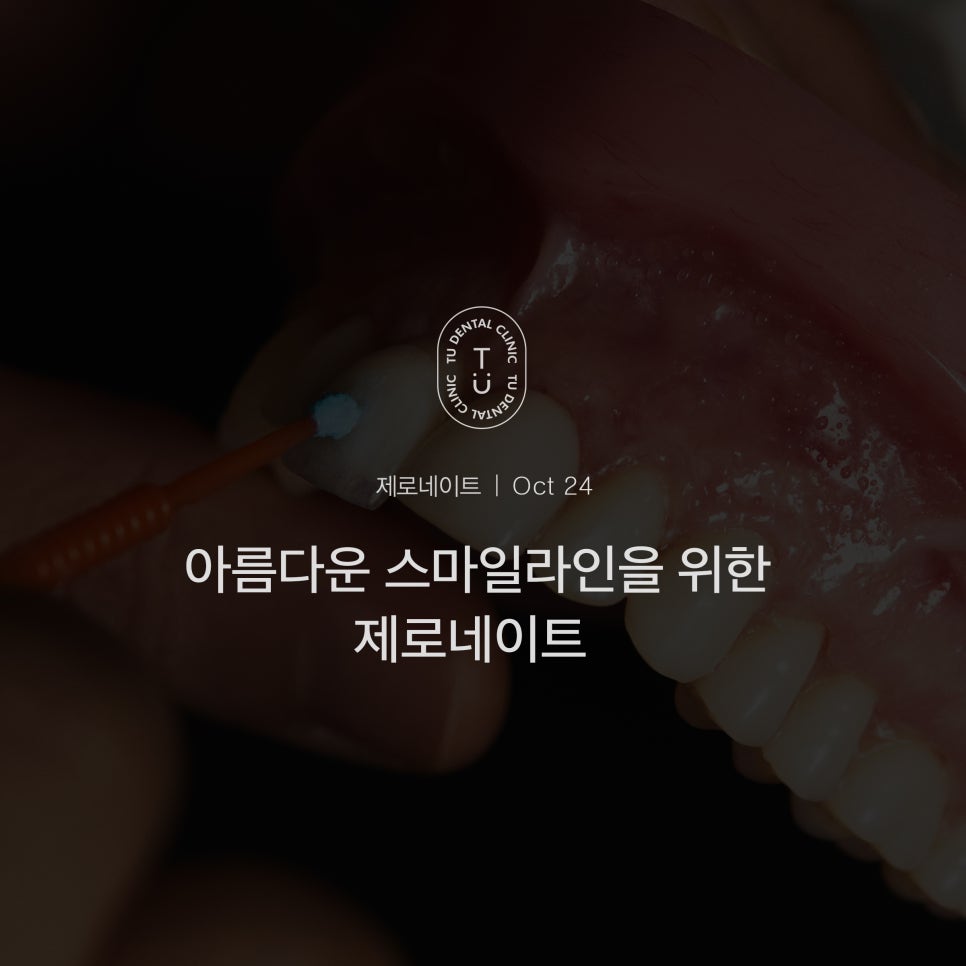 [티유치과] 아름다운 스마일라인을 위한 제로네이트 관련 이미지 1