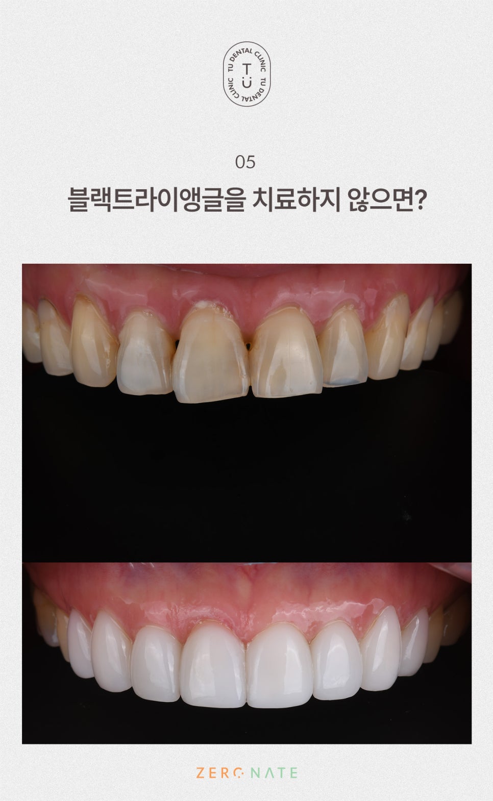 티유치과 블랙트라이앵글 제로네이트 [TU치과] 관련 이미지 6