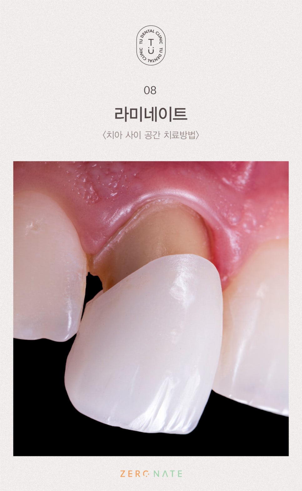 치아 사이 공간 치료방법, 티유치과[TU치과] 관련 이미지 9