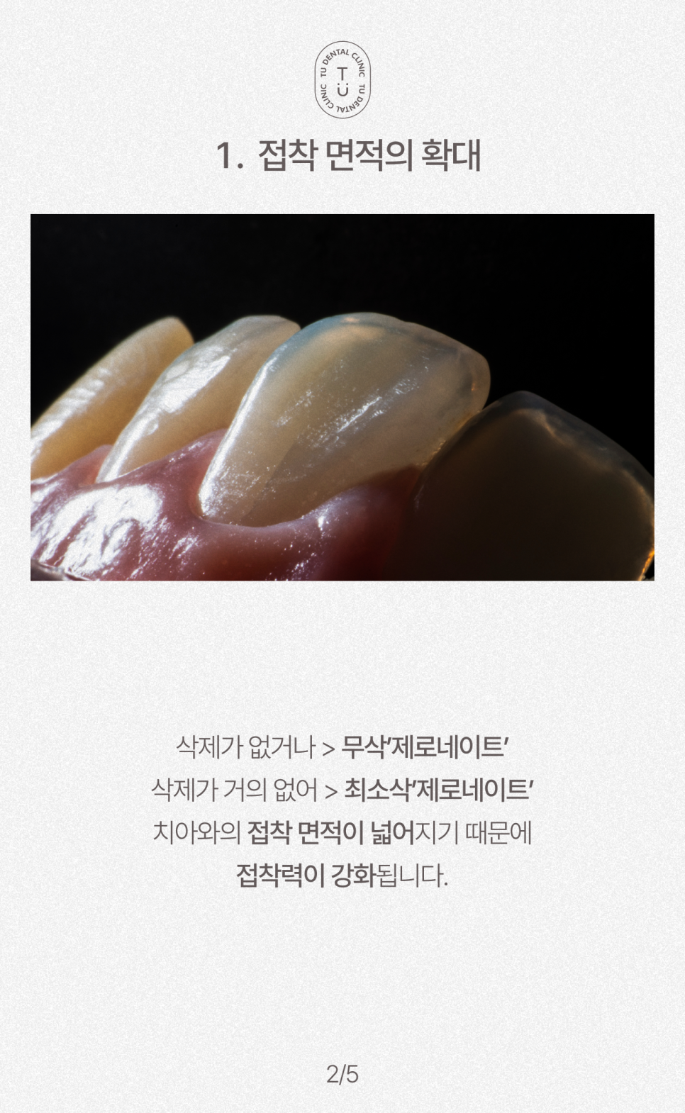 무삭제 라미네이트, 제로네이트 깨질까봐 걱정이신가요? [TU치과] 관련 이미지 3