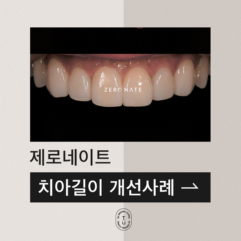 제로네이트 : 치아길이의 개선 사례 관련 이미지 1