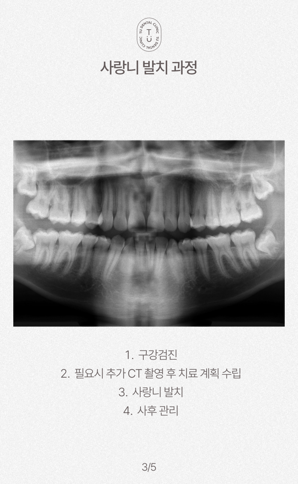 사랑니 안 아프게 발치하는 방법 알려드립니다, 티유치과[TU치과] 관련 이미지 4