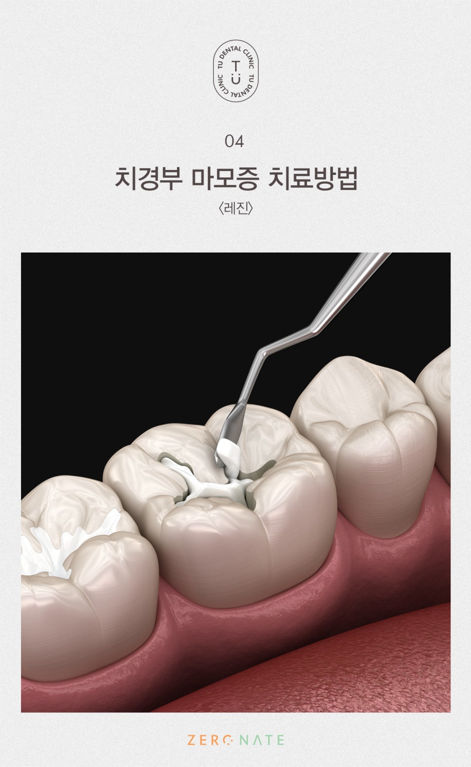 치경부 마모증 치료방법, 티유치과 제로네이트[TU치과] 관련 이미지 8