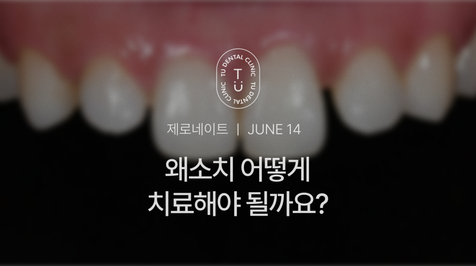 왜소치 치료방법, 작은치아 라미네이트, 제로네이트 알려드립니다! 티유치과[TU치과] 관련 이미지 1