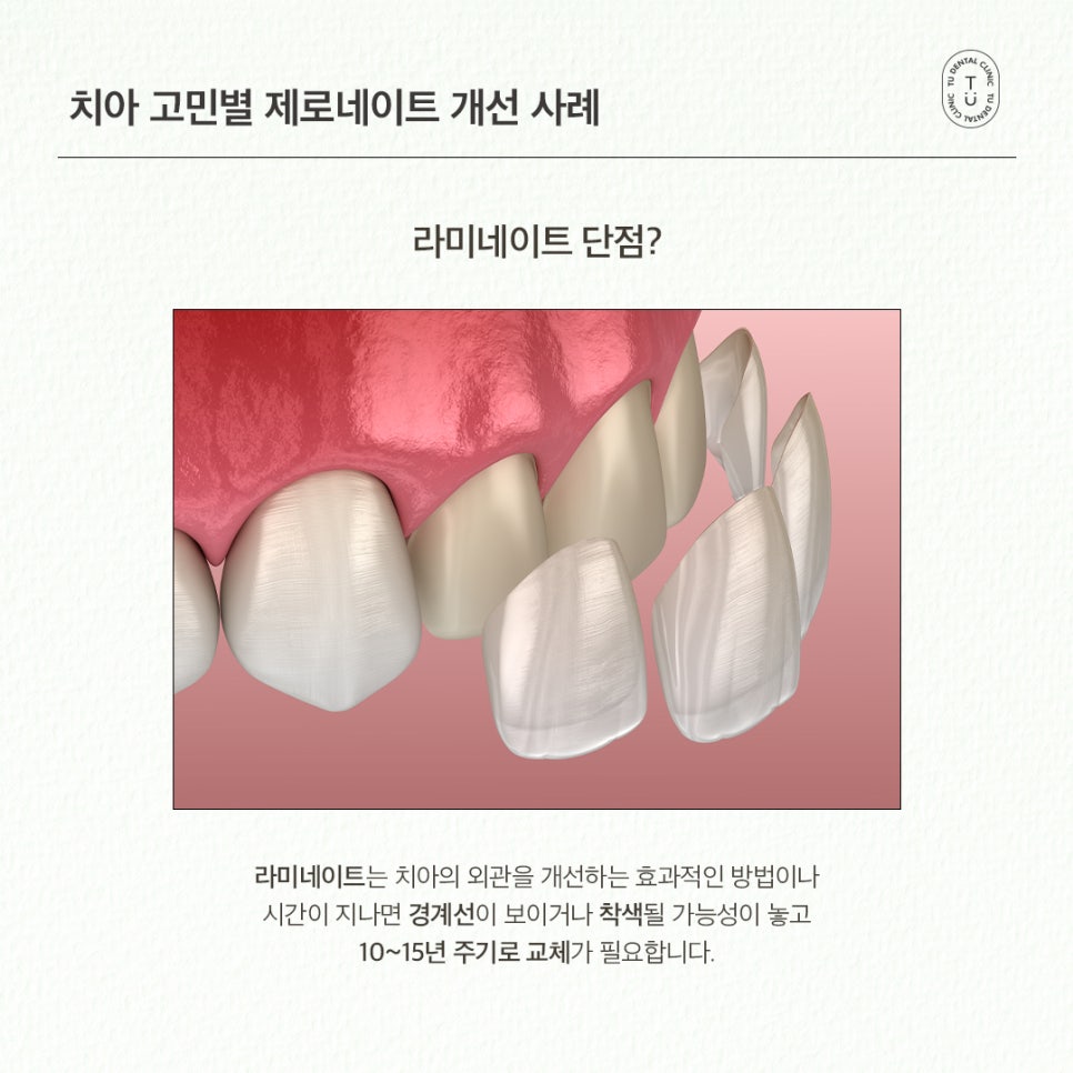 치아 고민별 제로네이트 개선 사례 (유형별 라미네이트 전후) 관련 이미지 2