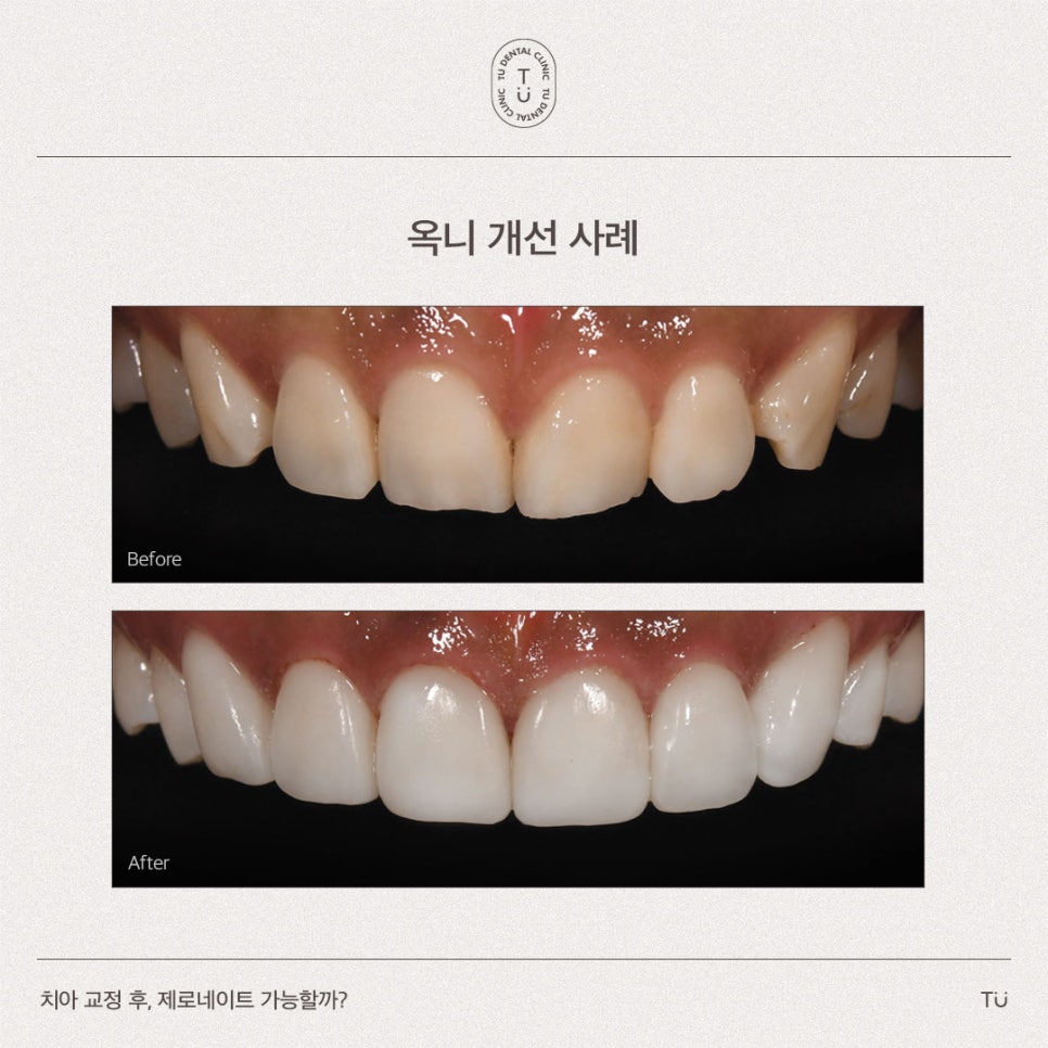 [티유치과] 치아 교정 후, 제로네이트 가능할까요?[TU치과] 관련 이미지 4