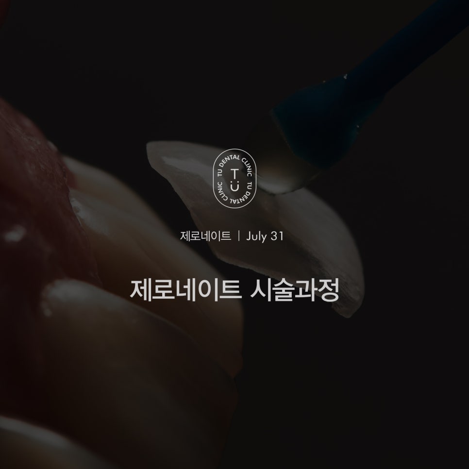 티유치과 제로네이트 시술과정 [TU치과] 관련 이미지 1