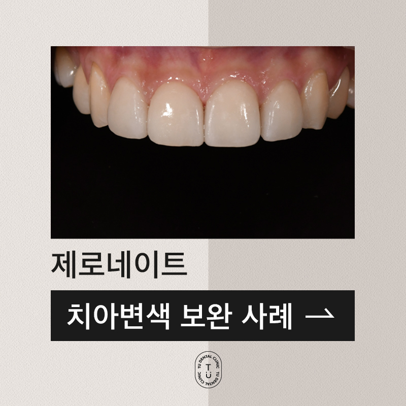 변색된 치아 ZERONATE로 극복 가능하다면? 관련 이미지 1