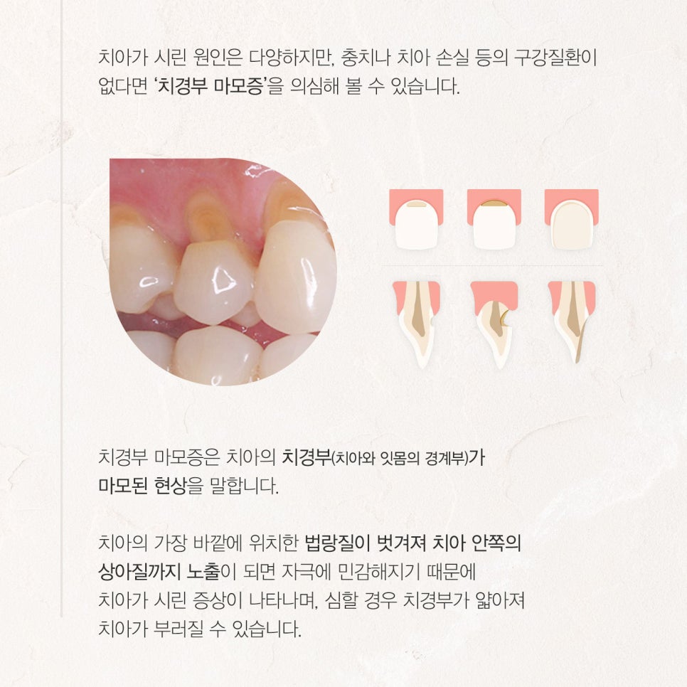 티유치과 7월 매거진, 치경부 마모증 치료법 [TU치과] 관련 이미지 2
