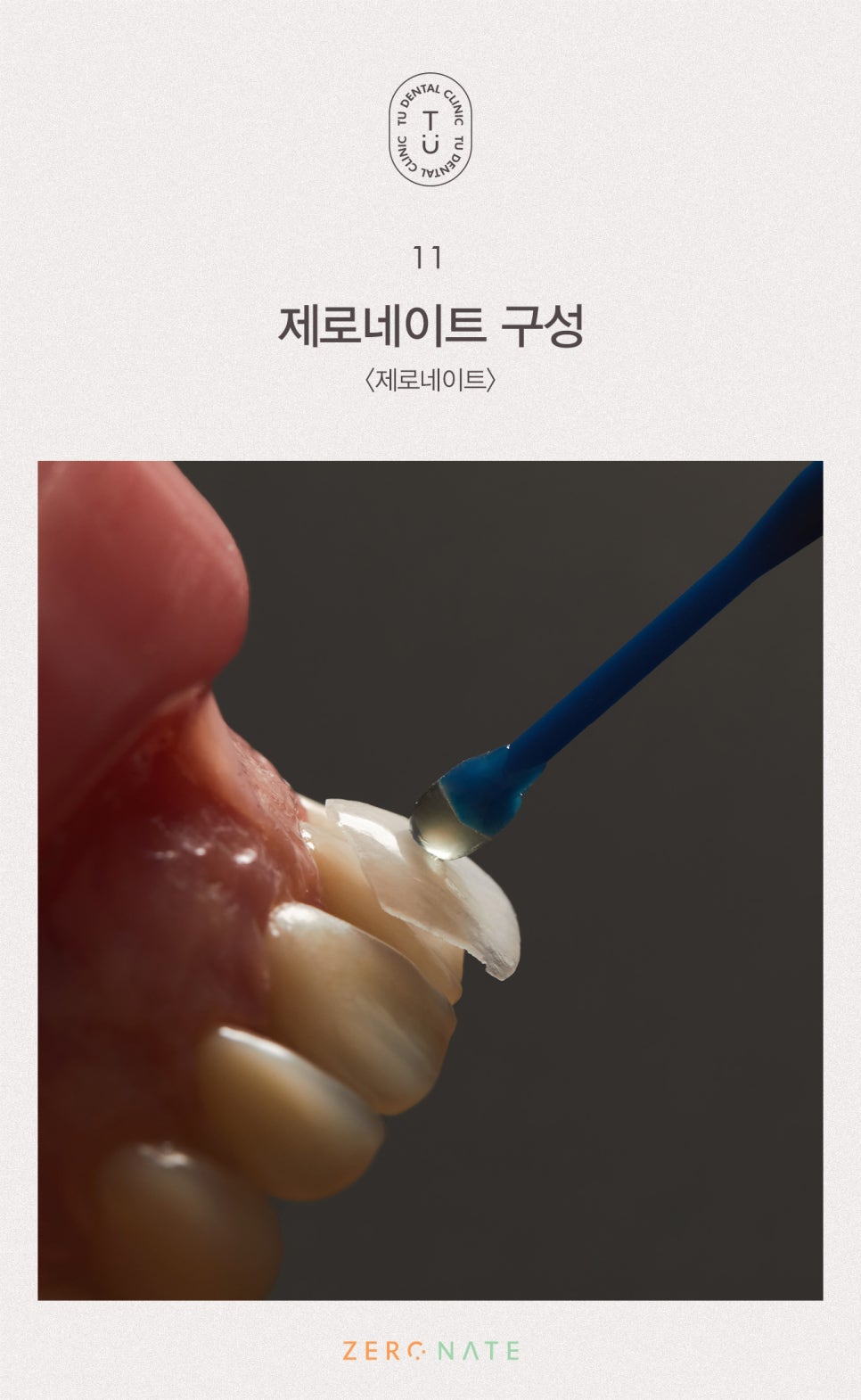 티유치과 선택적 치아 성형 [TU치과] 관련 이미지 12