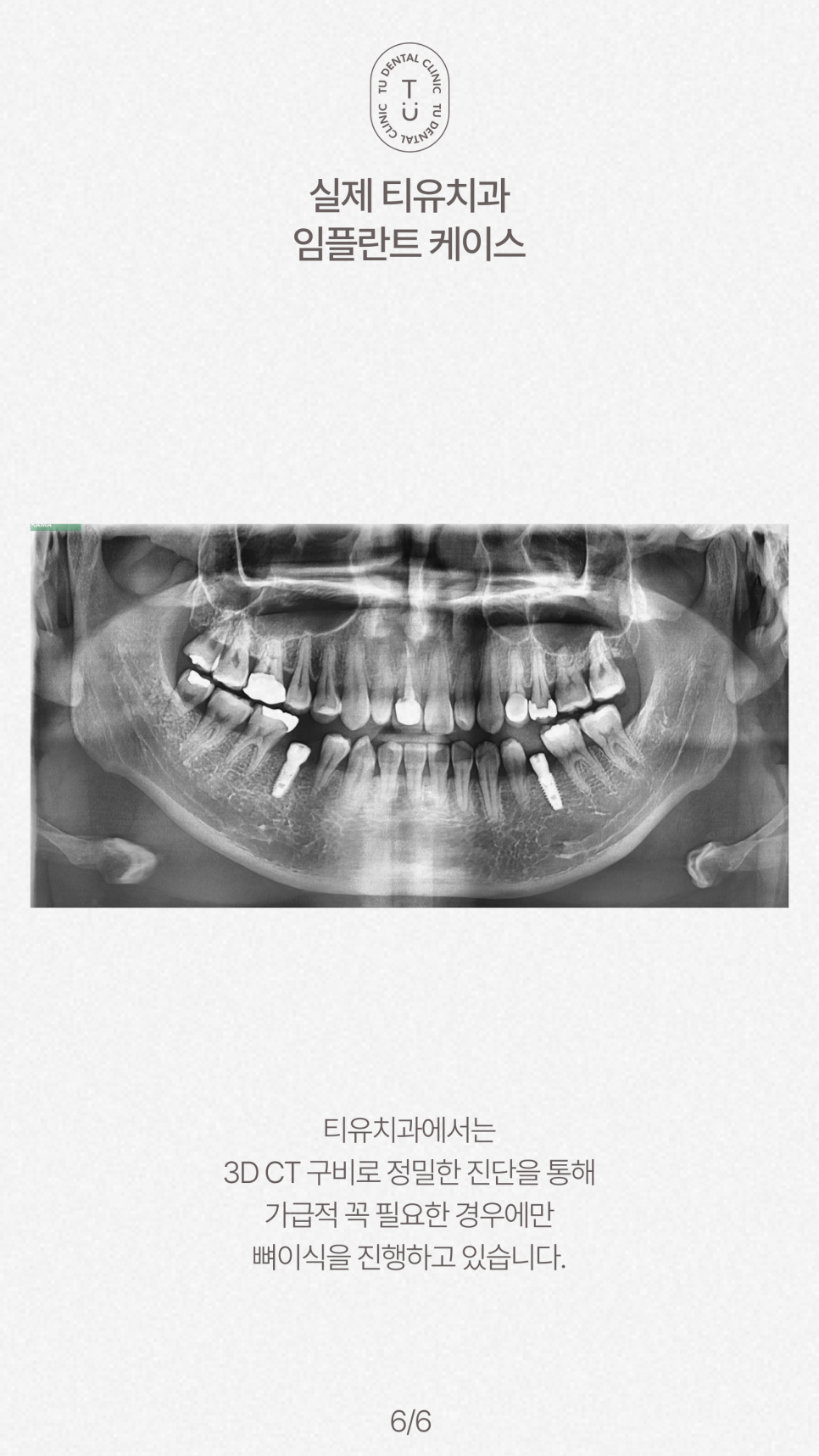 임플란트 뼈이식 꼭 해야할까요? 티유치과[TU치과] 관련 이미지 7