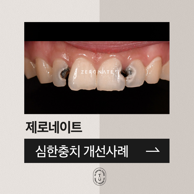 TU 제로네이트 사례 : 심한충치의 개선 관련 이미지 1