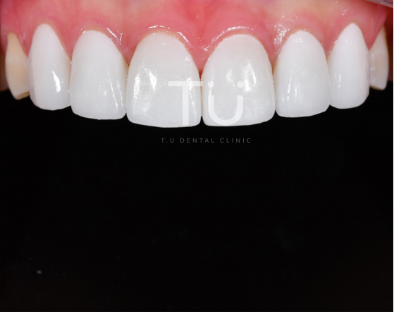 누렇게 변색된 치아의 개선 case : 제로네이트 관련 이미지 3
