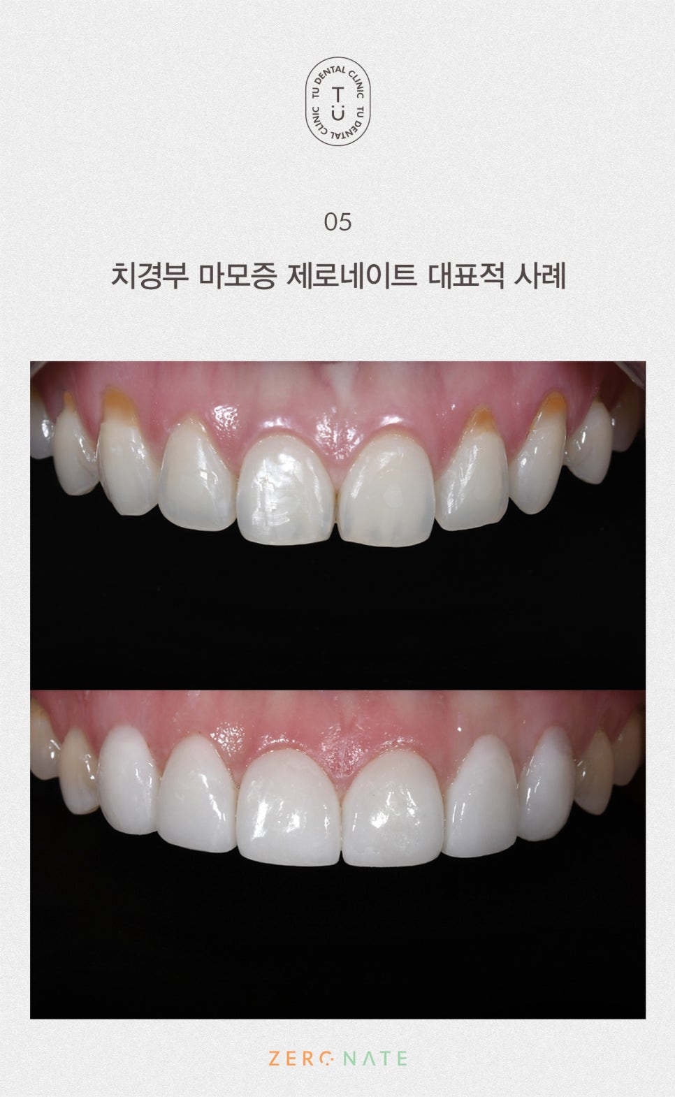 치경부 마모증 치료방법, 티유치과 제로네이트[TU치과] 관련 이미지 10