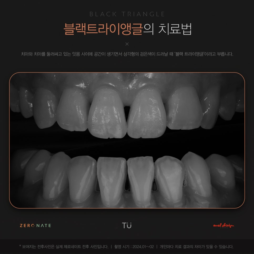 티유치과 4월 매거진, 블랙트라이앵글 치아의 치료법 [TU치과] 관련 이미지 1