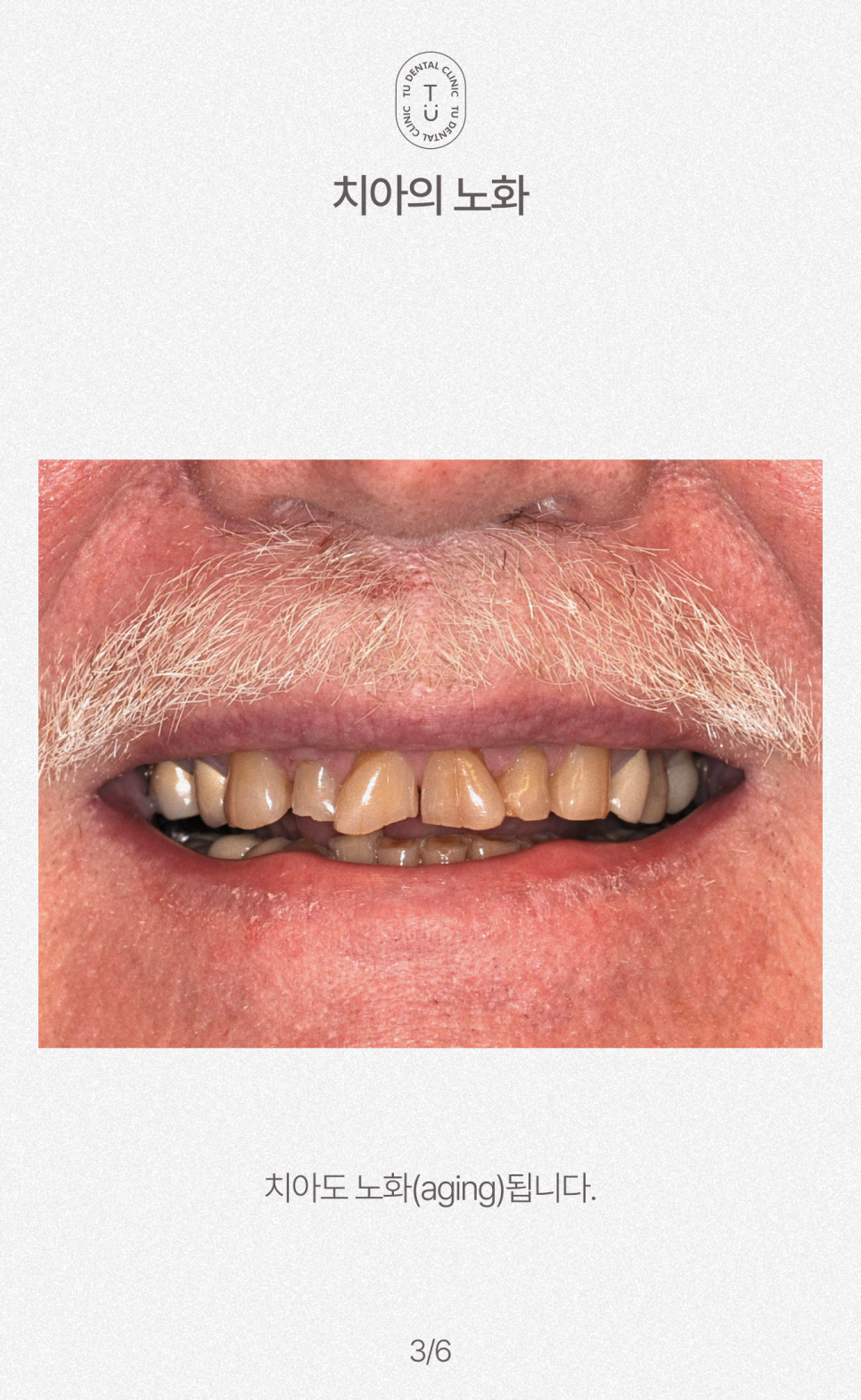 노화된 치아에 제로네이트 하세요, 티유치과[TU치과] 관련 이미지 4