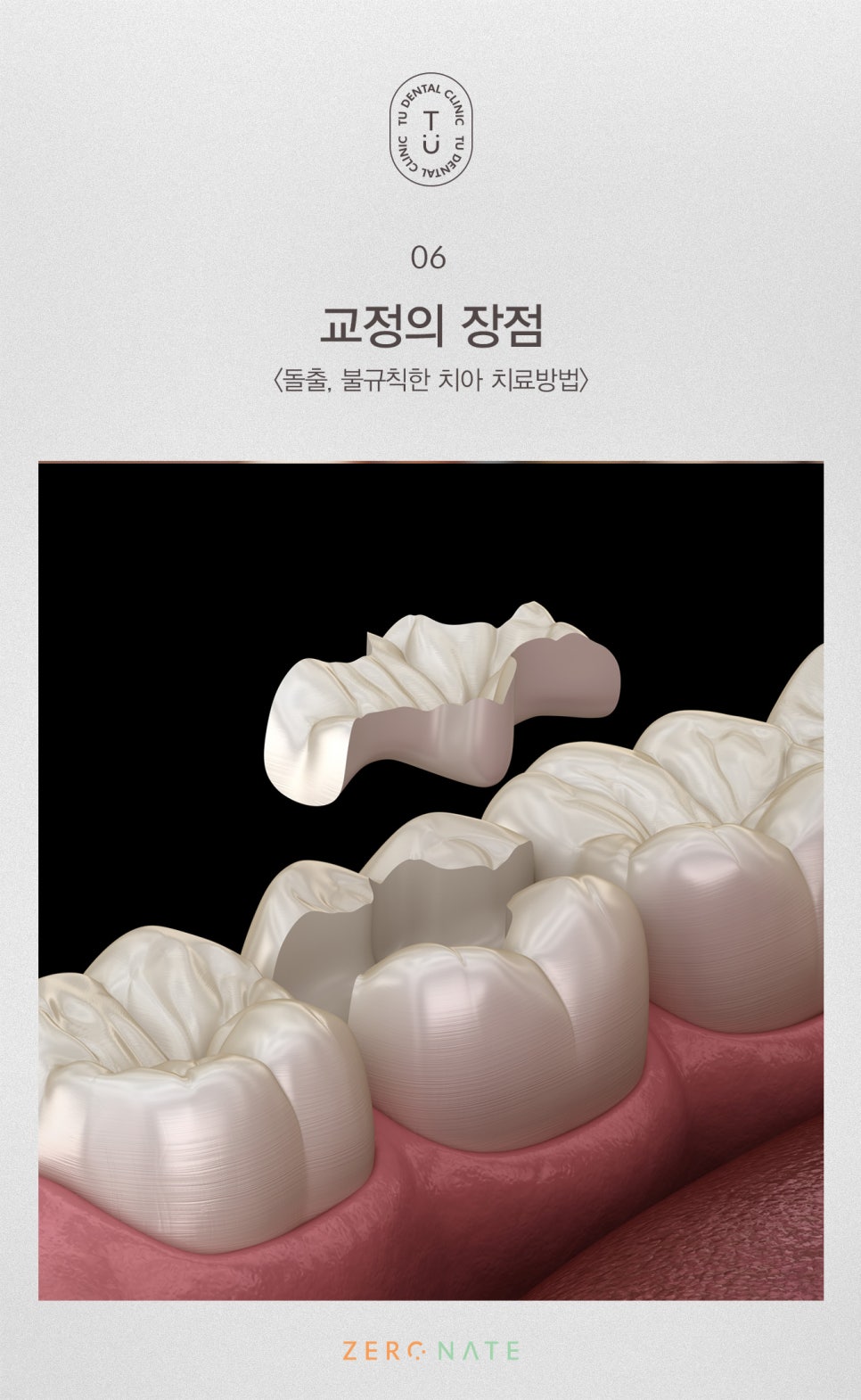 티유치과 돌출,불규칙한 치아 제로네이트[TU치과] 관련 이미지 7