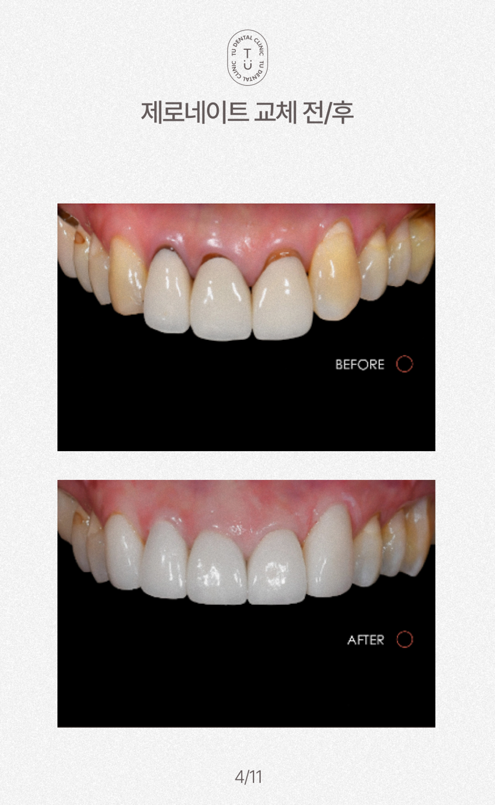 오래된 라미네이트 교체하셔야 됩니다, 티유치과[TU치과] 관련 이미지 5