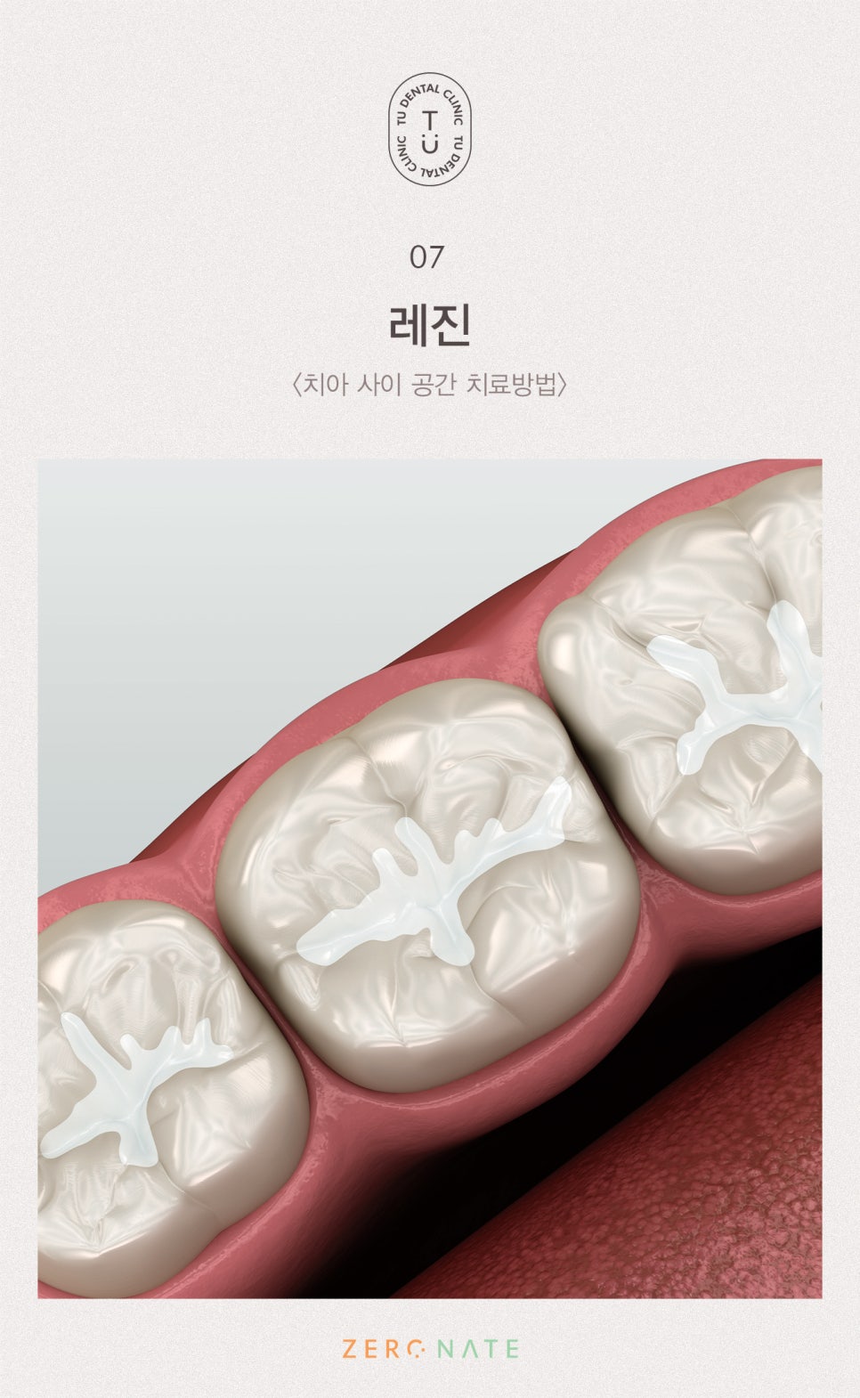 치아 사이 공간 치료방법, 티유치과[TU치과] 관련 이미지 8