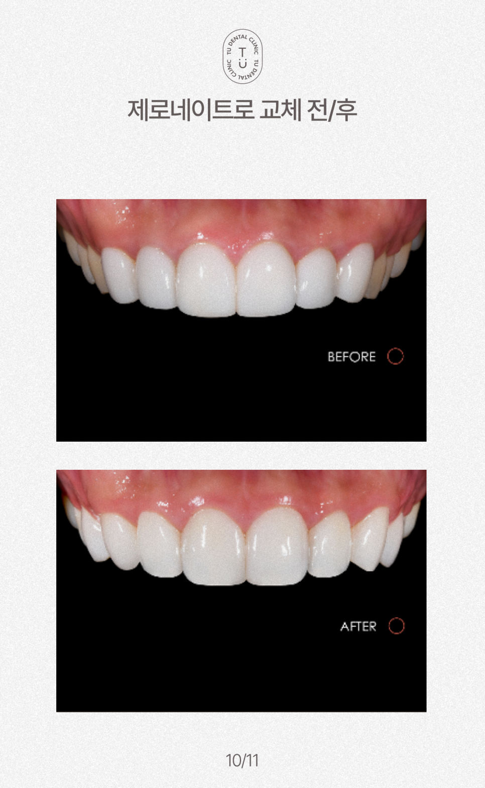 오래된 라미네이트 교체하셔야 됩니다, 티유치과[TU치과] 관련 이미지 11