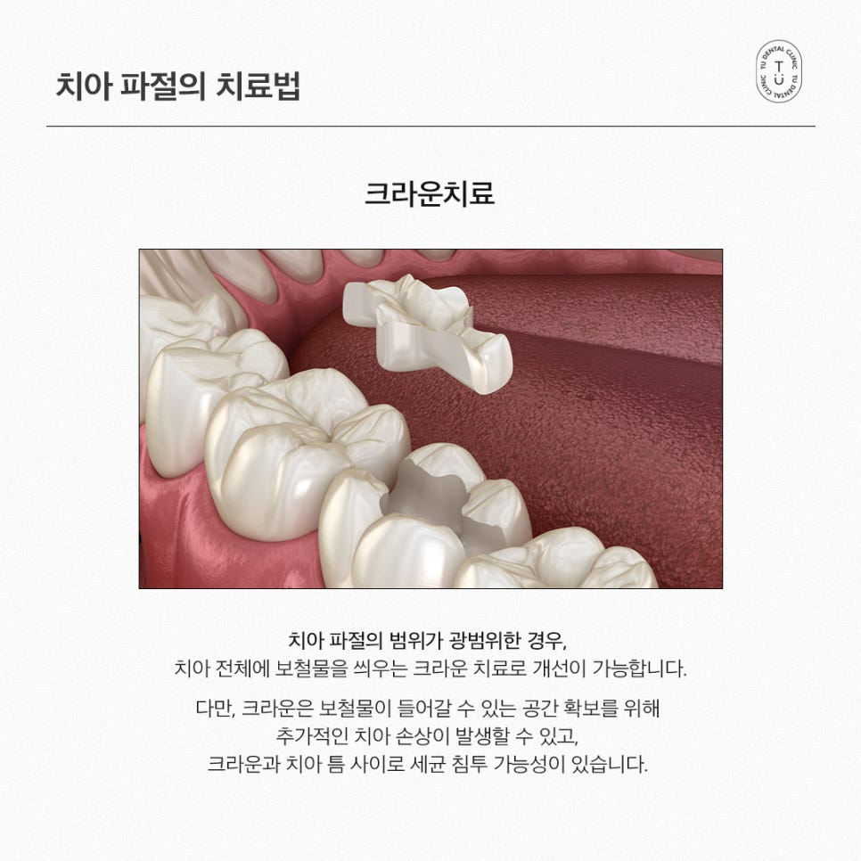 [티유치과] 치아 파절의 치료법, 제로네이트 관련 이미지 5