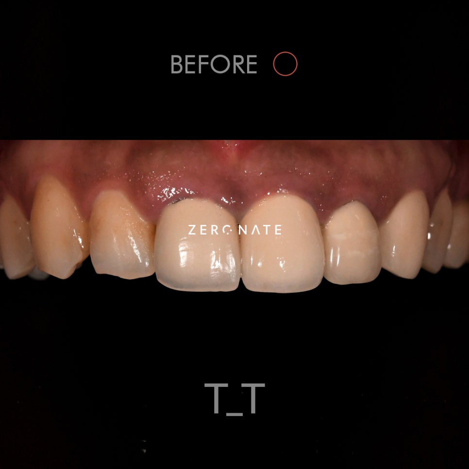 TU치과 제로네이트 사례 : 치아모양 개선 관련 이미지 2