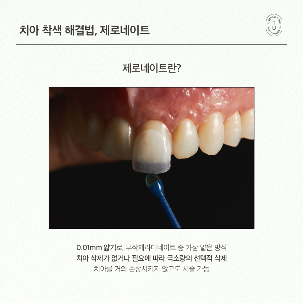 치아착색 제거, 손상없이 자연스럽게 티유치과 제로네이트 관련 이미지 4