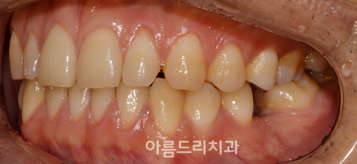벌어진앞니부분교정 짧은기간 치아교정 관련 이미지 5