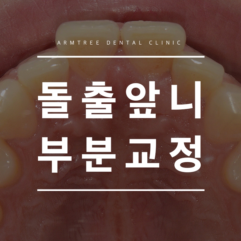 입툭튀교정 돌출앞니부분교정 후기는 아름드리치과 관련 이미지 1