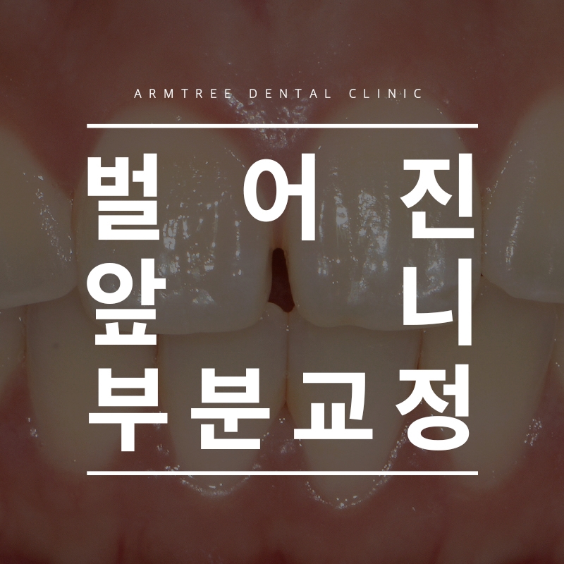 벌어진앞니부분교정 신논현역 아름드리치과 관련 이미지 1