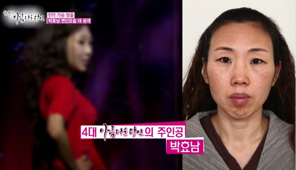 이현정원장의 아름다운 당신 시즌 1(4회 박효남 도전자) 돌출입 치아교정 관련 이미지 8