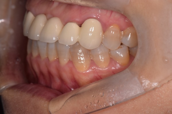 앞니 크라운 재치료 & 잇몸성형 _건강하게 . 예뻐지는 방법 관련 이미지 6