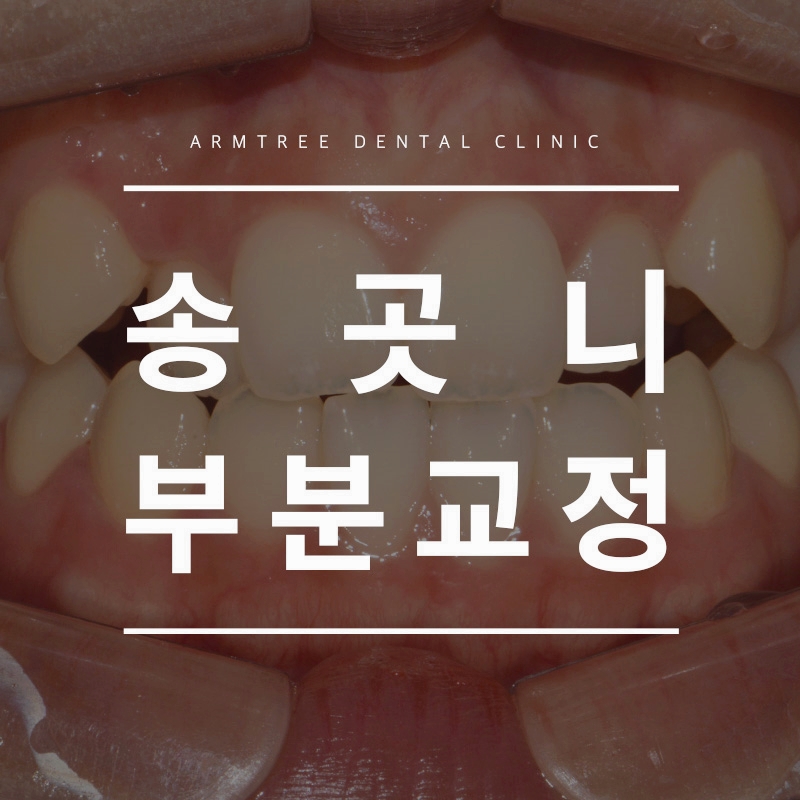 덧니부분교정 앞니송곳니는 아름드리치과 관련 이미지 1