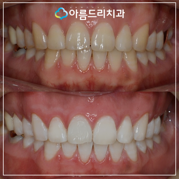 치과 치아미백 후기 궁금하다면 관련 이미지 1