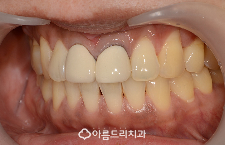 실활치미백 치은 잇몸퇴축 재생으로 동안치아 관련 이미지 5