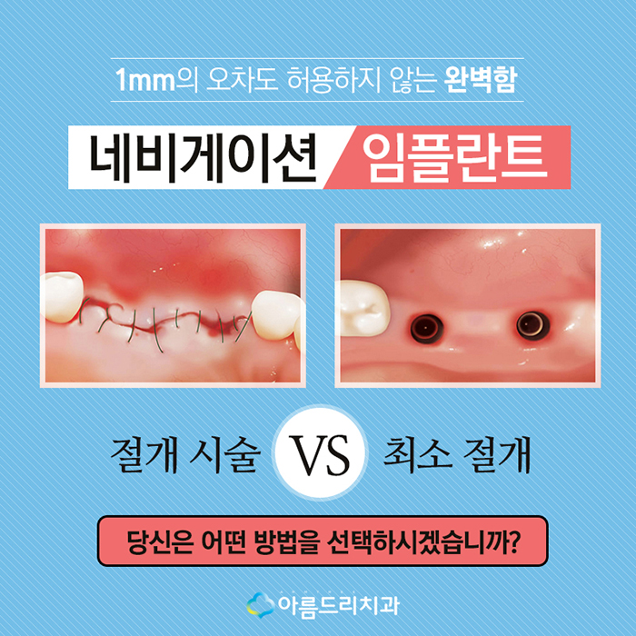 디지털인플란트 치아인플란트 정확도 차이 관련 이미지 3