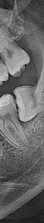 반포치과 사랑니발치 치과를 찾고있다면 관련 이미지 12