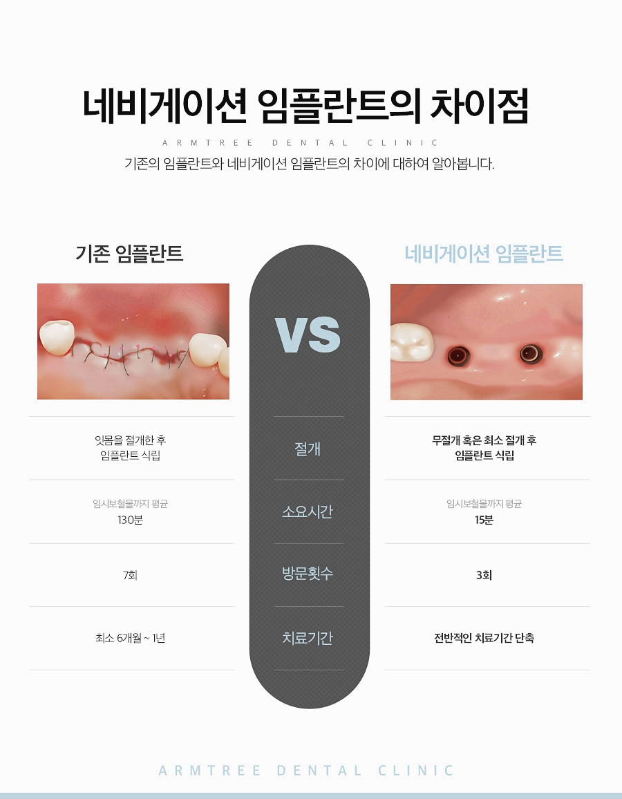 네비게이션임플란트 꼼꼼히 따져보면 관련 이미지 4