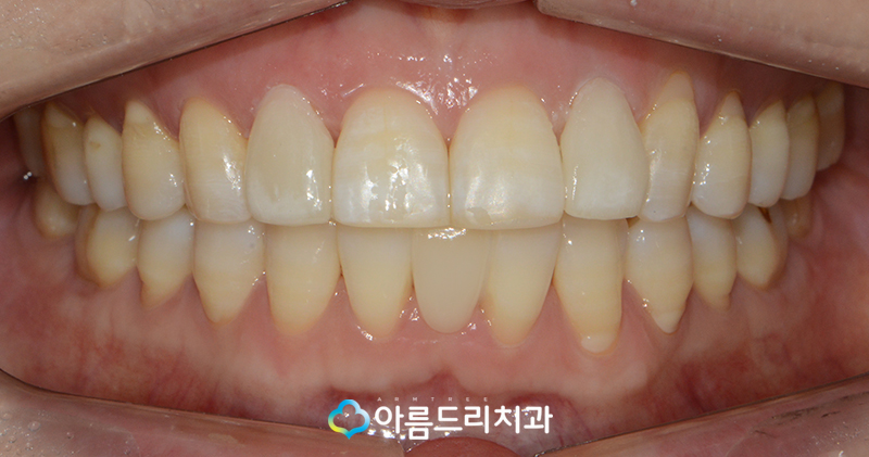 앞니브릿지 치과 치료후기 메릴랜드브릿지 관련 이미지 9