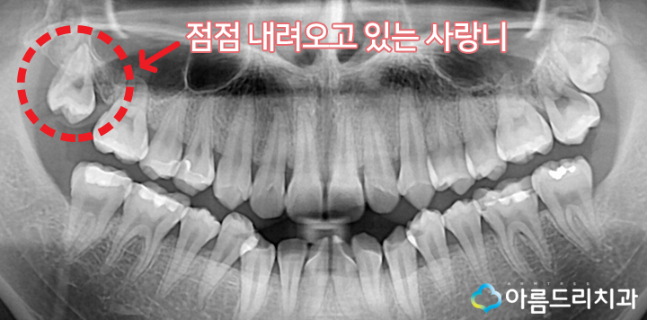 신논현역치과 사랑니 꼭 빼야하나요? 관련 이미지 5