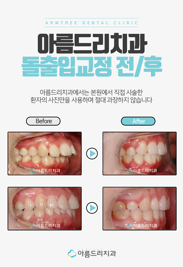 돌출입치아교정후기 돌출입설측교정 문제NO! 관련 이미지 6