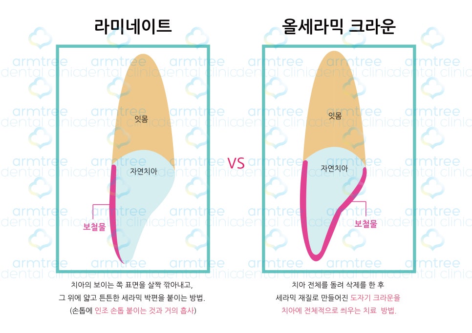 앞니 라미네이트_왜소치아 (최소삭제) 관련 이미지 4