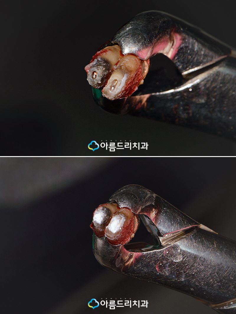 치아재식술 자연치아 살리기 후기 관련 이미지 7