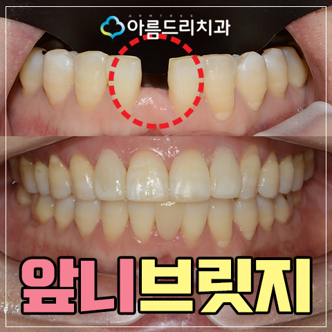 앞니브릿지 치과 치료후기 메릴랜드브릿지 관련 이미지 1