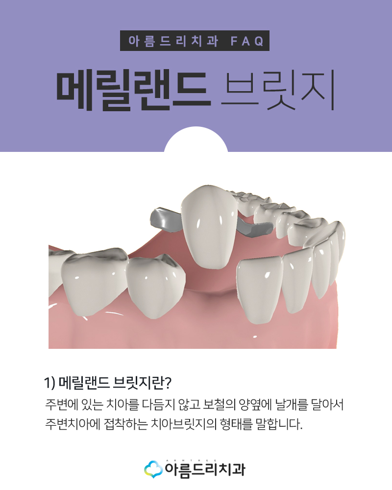 앞니브릿지 치과 치료후기 메릴랜드브릿지 관련 이미지 6