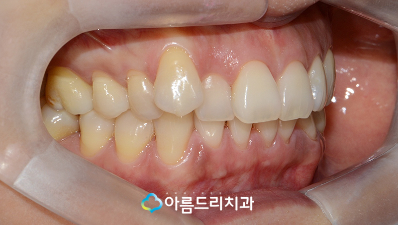 드라큘라이빨 송곳니교정 부분교정후기 관련 이미지 4