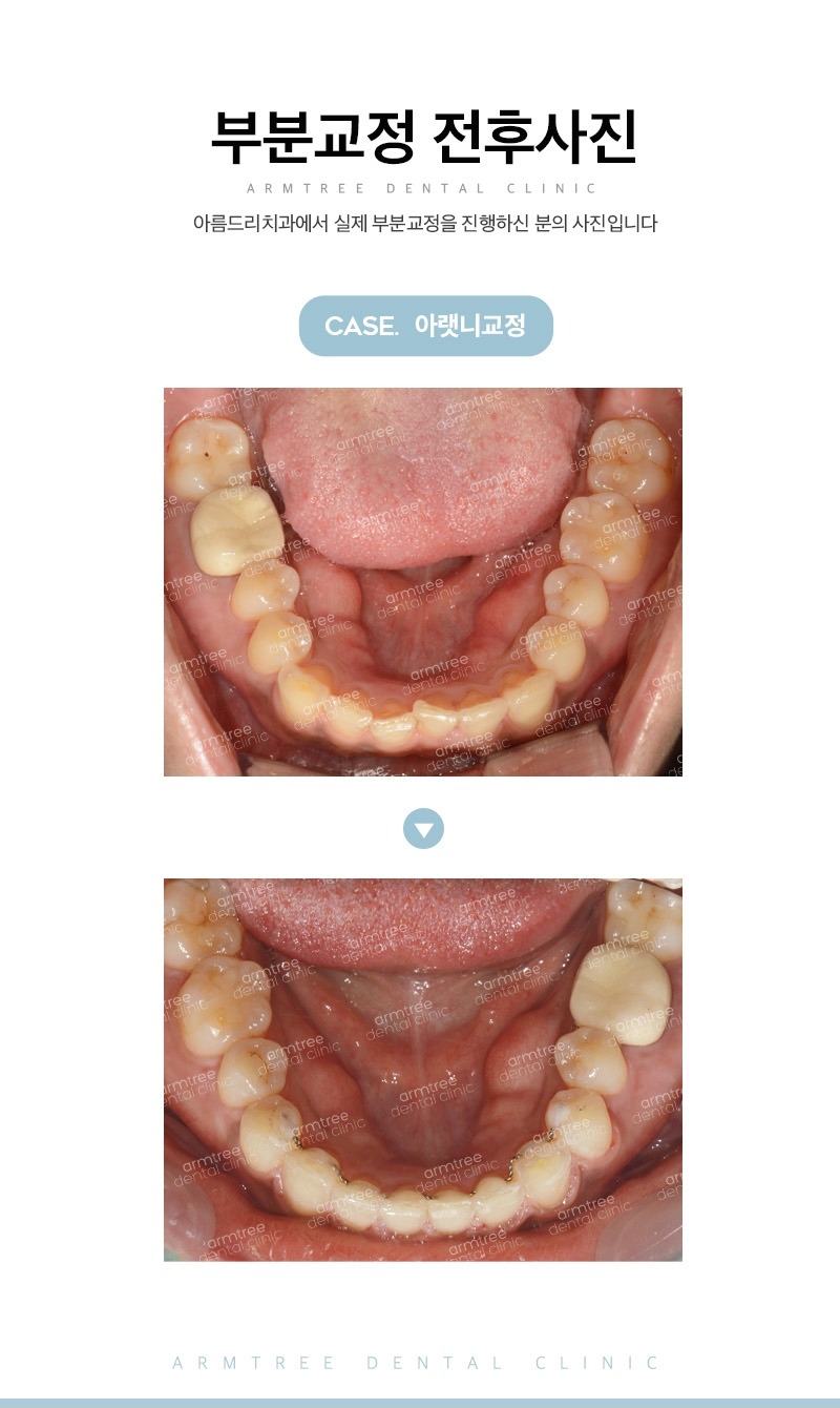 부분교정기간 다양한후기 아름드리치과 관련 이미지 13