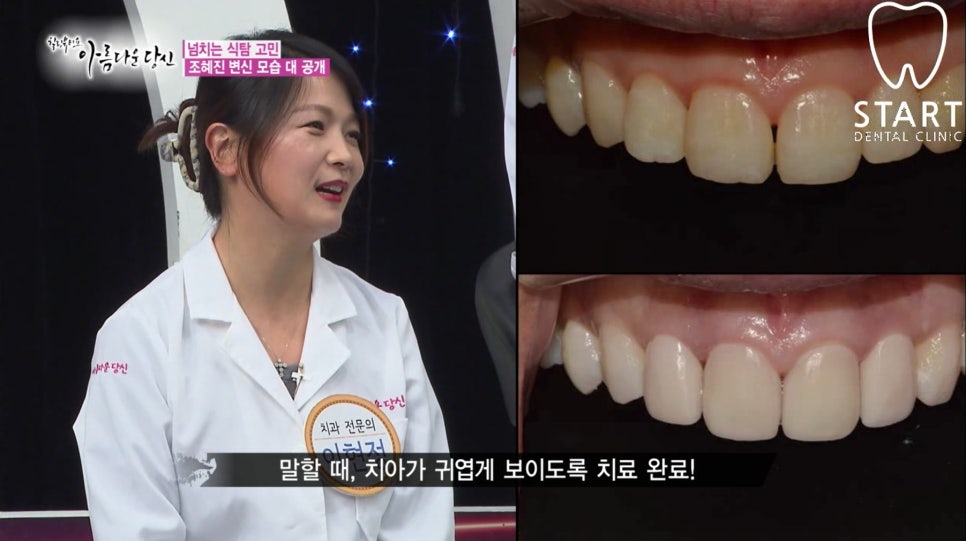 이현정 원장의 아름다운 당신 시즌 1 (9회 조혜진 도전자) 치아성형, 라미네이트, 치아미백, 화이트랩스 관련 이미지 3