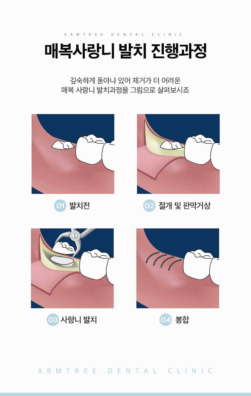 매복사랑니 발치후기 통증없는 아름드리치과 관련 이미지 4